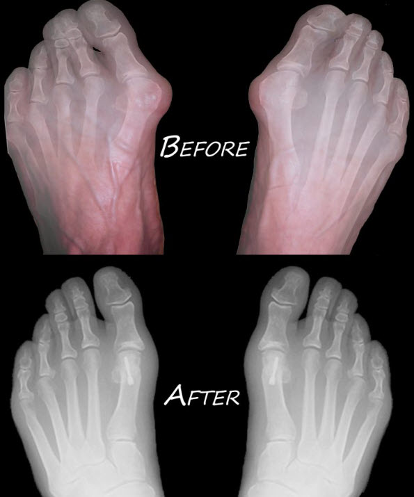 Bunions Main