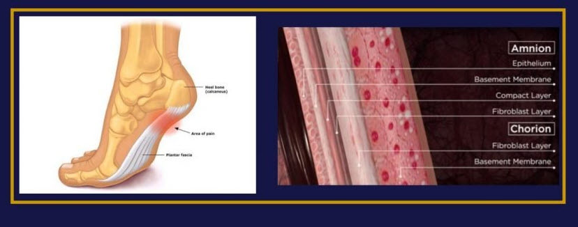 Plantar Fascia Plantar Fasciitis Heel Pain Treatments in Chicago Wheeling IL 830x328