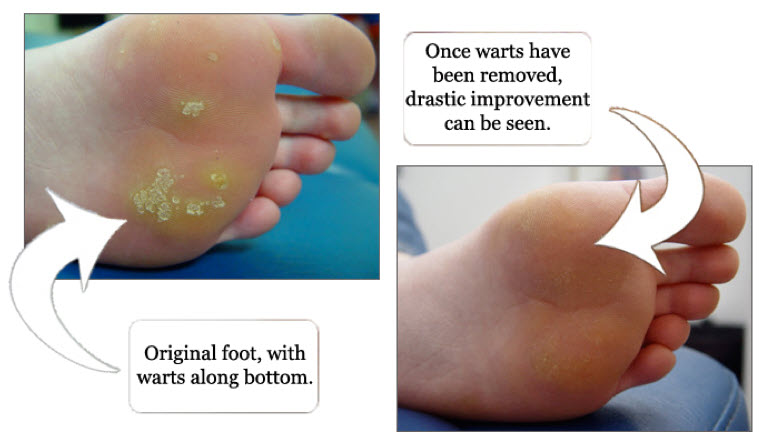 plantar wart treatment services in Chicago